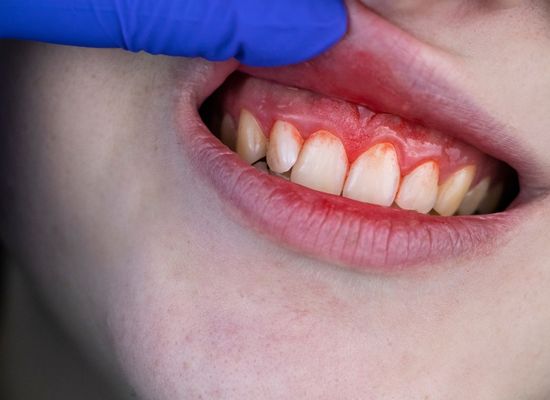 Diagnóstico Periodontitis | Dentista en Sevilla