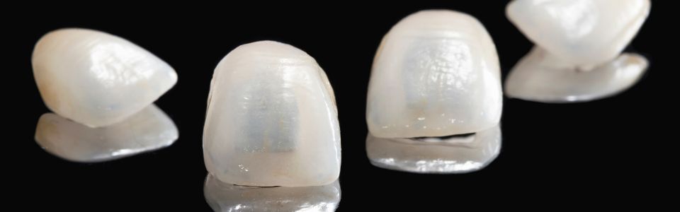 carillas dentales sevilla | Sánchez Solís Clínica