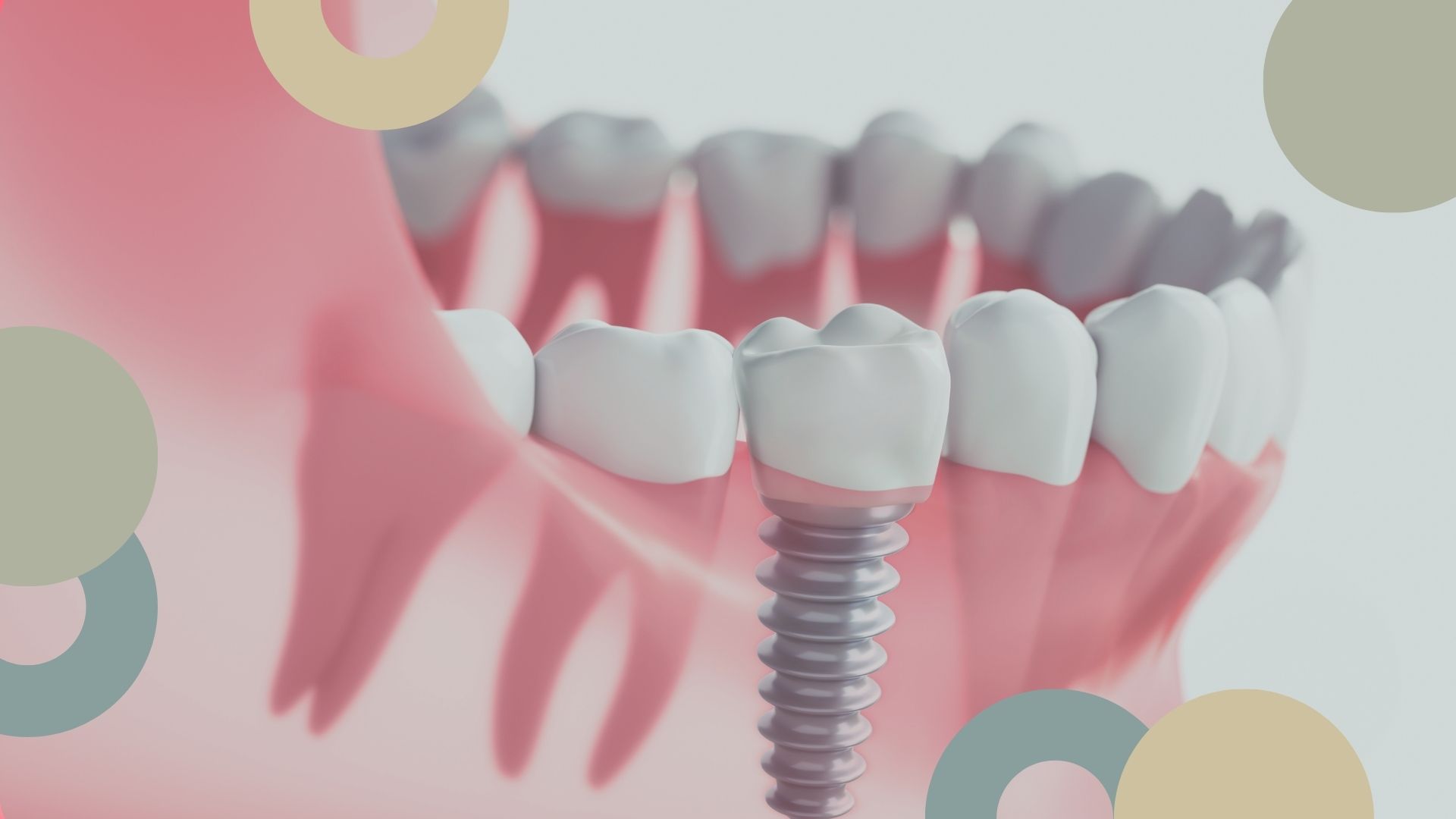 Implantología Dental | Clínica Dental Sánchez Solís